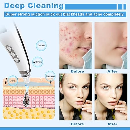 5-in-1 Electric Blackhead Remover Vacuum – 5 Suction Levels & Probes
